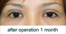 plastic-surgery-blepharoplasty